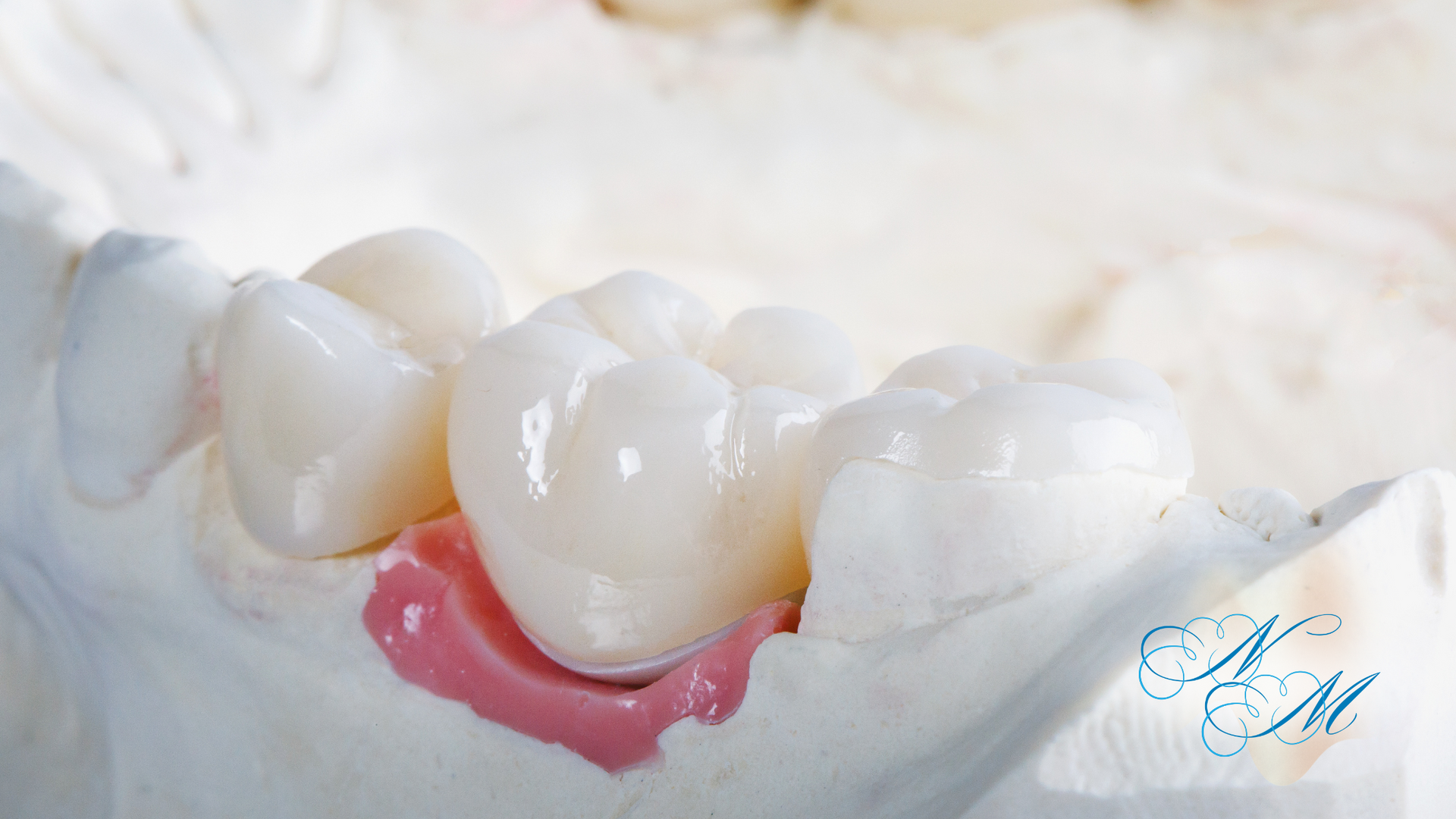 Dental model with white ceramic crown on a pink base, with other teeth visible in the background.
