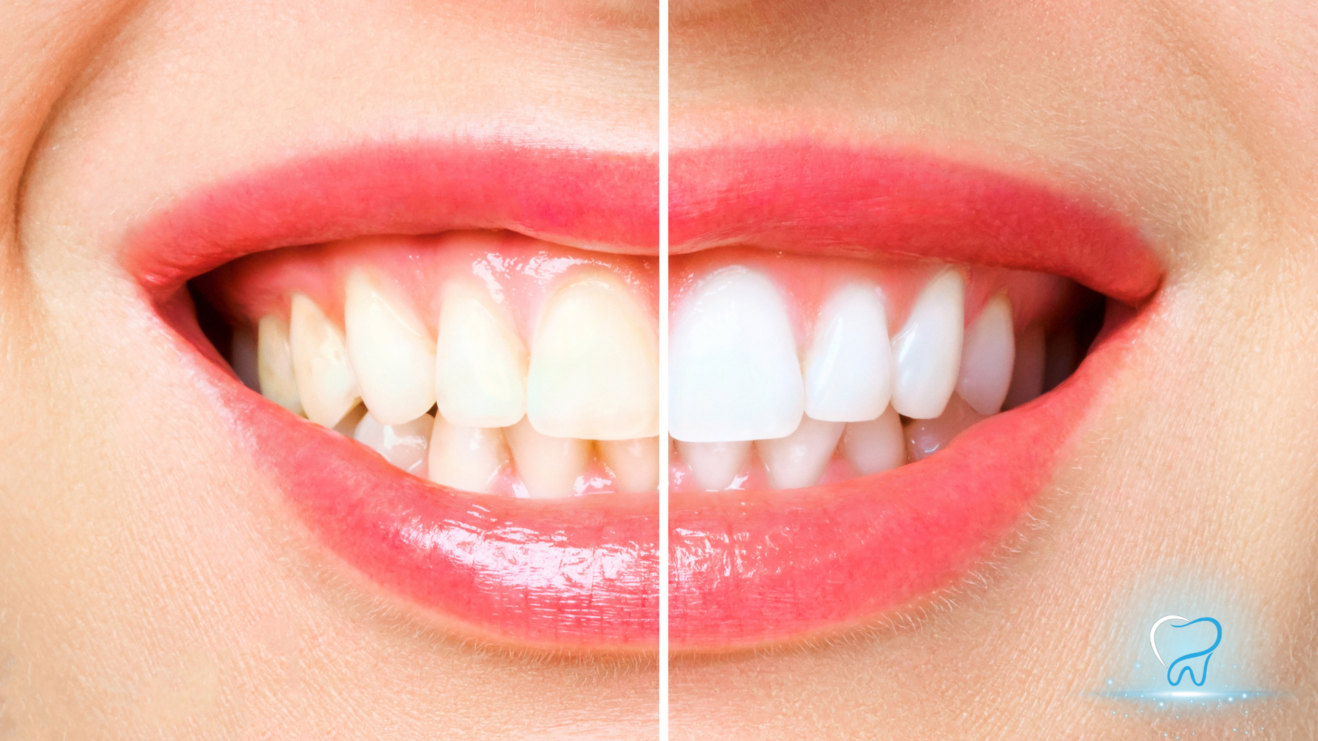 Close-up of smiling lips and teeth split into natural and brighter white shades for comparison