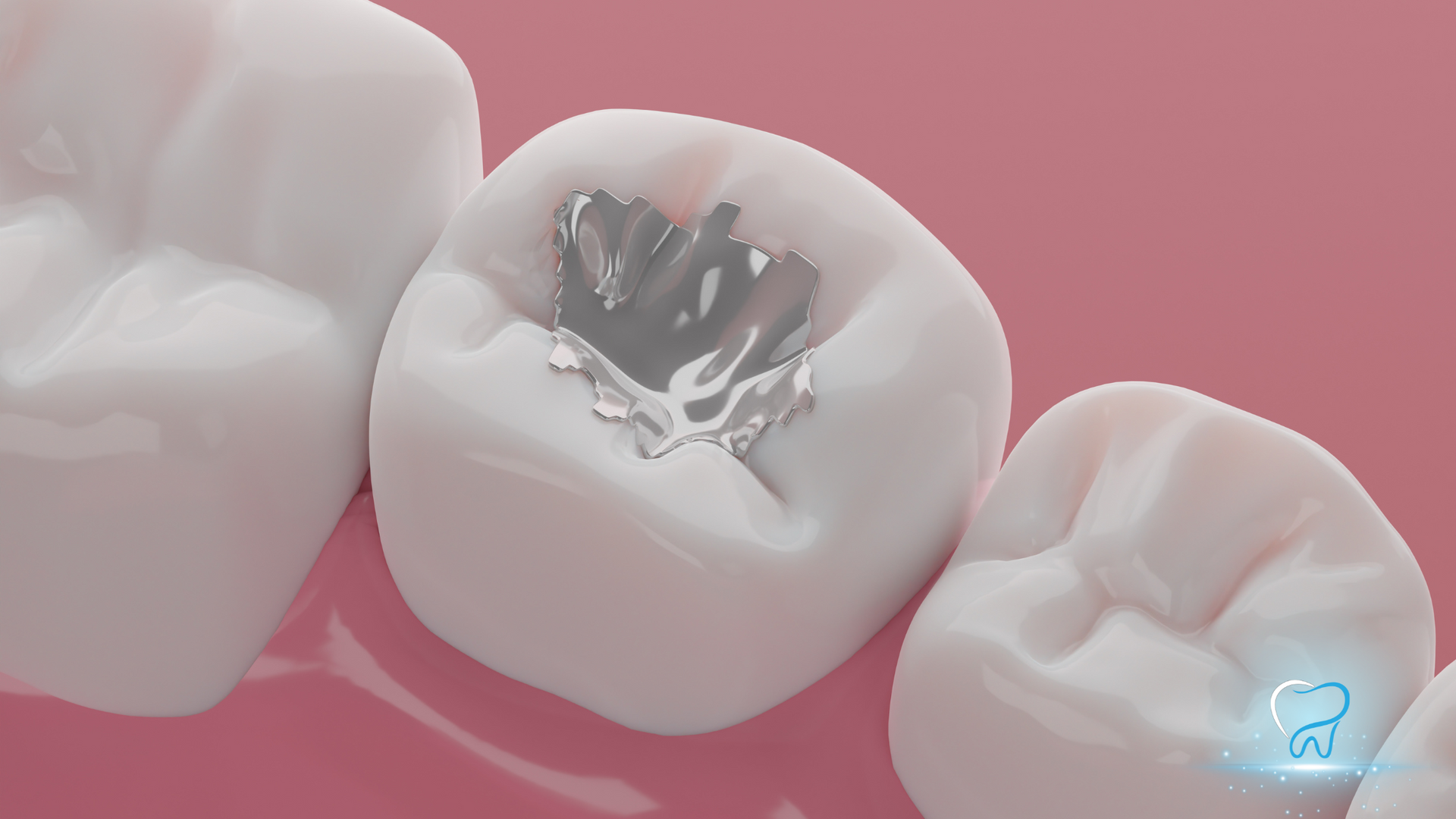 Close-up of three white teeth, one with a silver filling, against a pink background