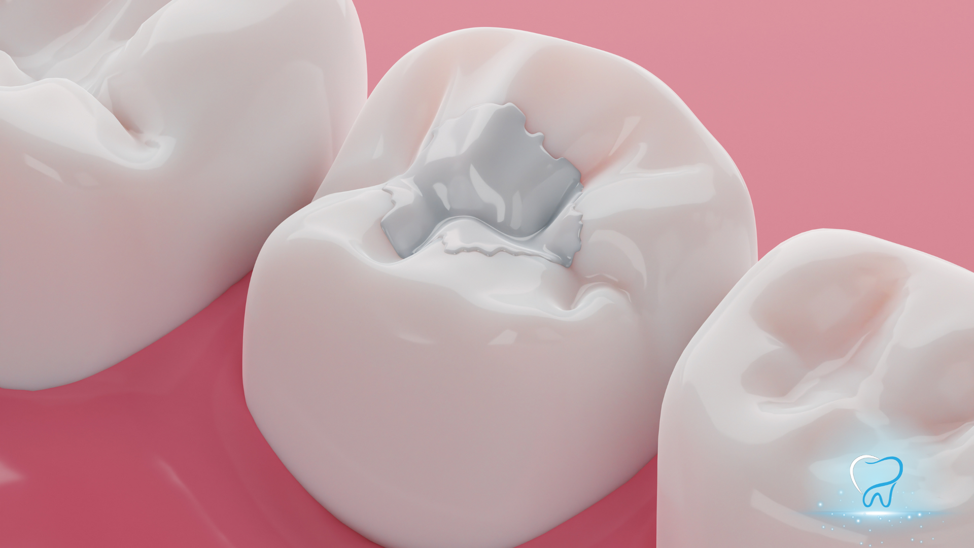Close-up of white teeth with a silver dental filling on a molar, against pink gums.