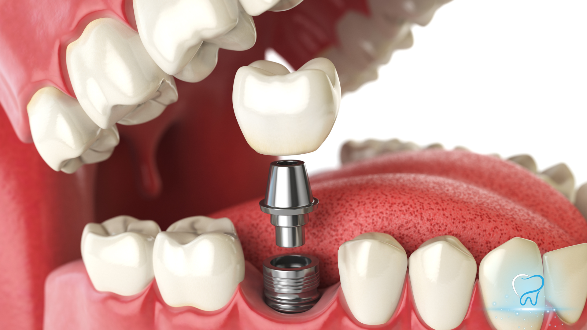 3D dental implant in gums with open mouth and surrounding teeth