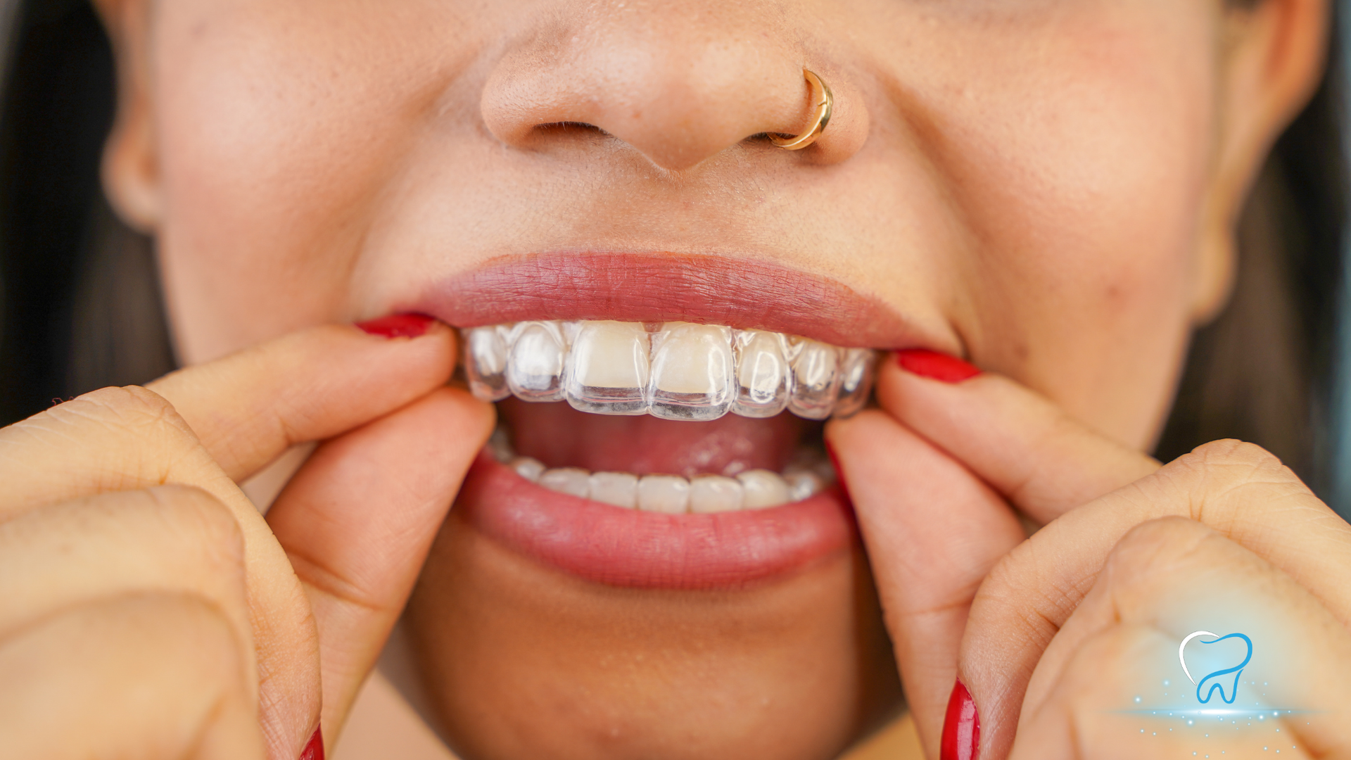 Close-up of a person adjusting clear dental aligners on their teeth with both hands.