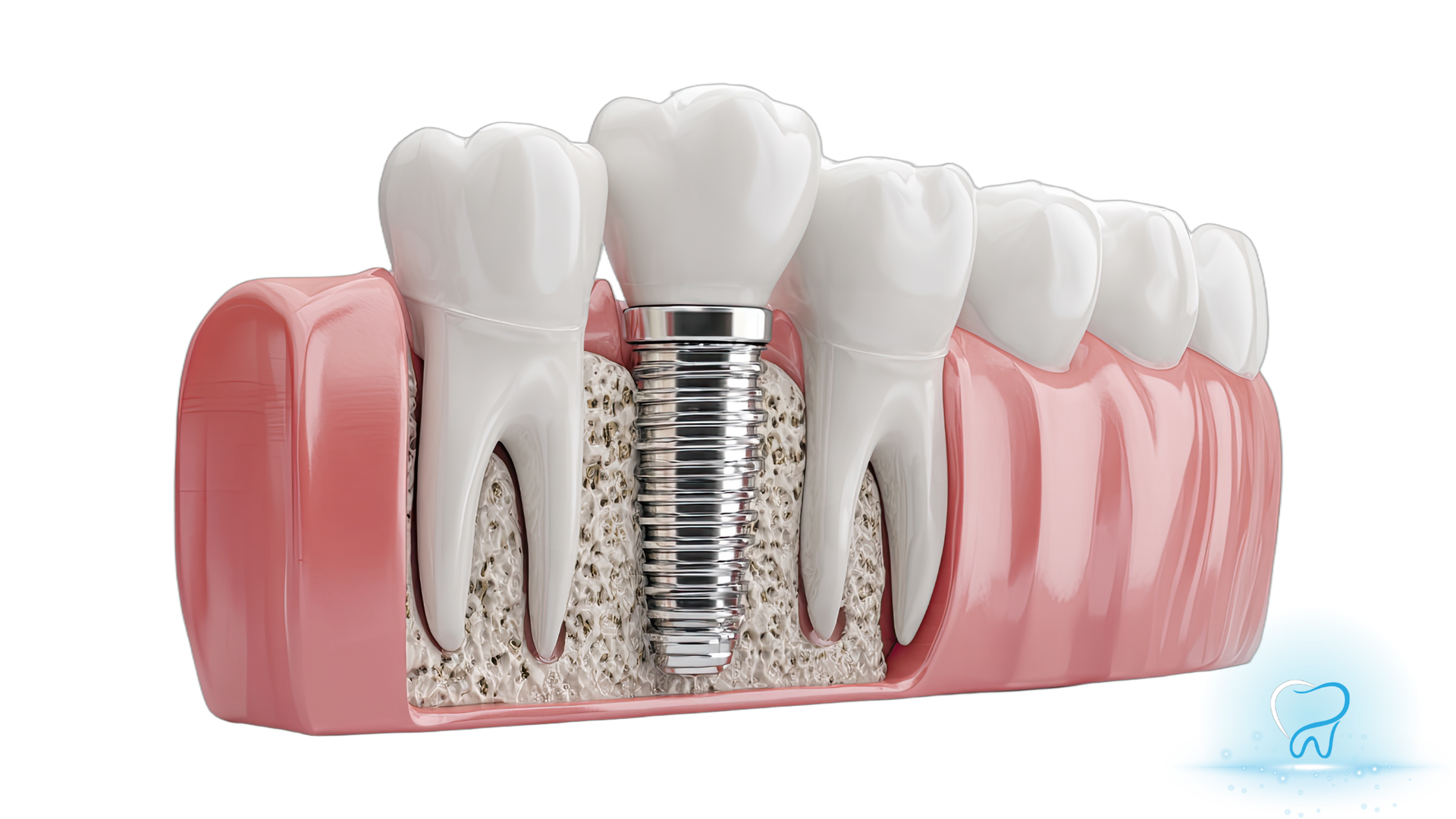 Dental implant model with white teeth and pink gums, showing a metal implant post in the jaw