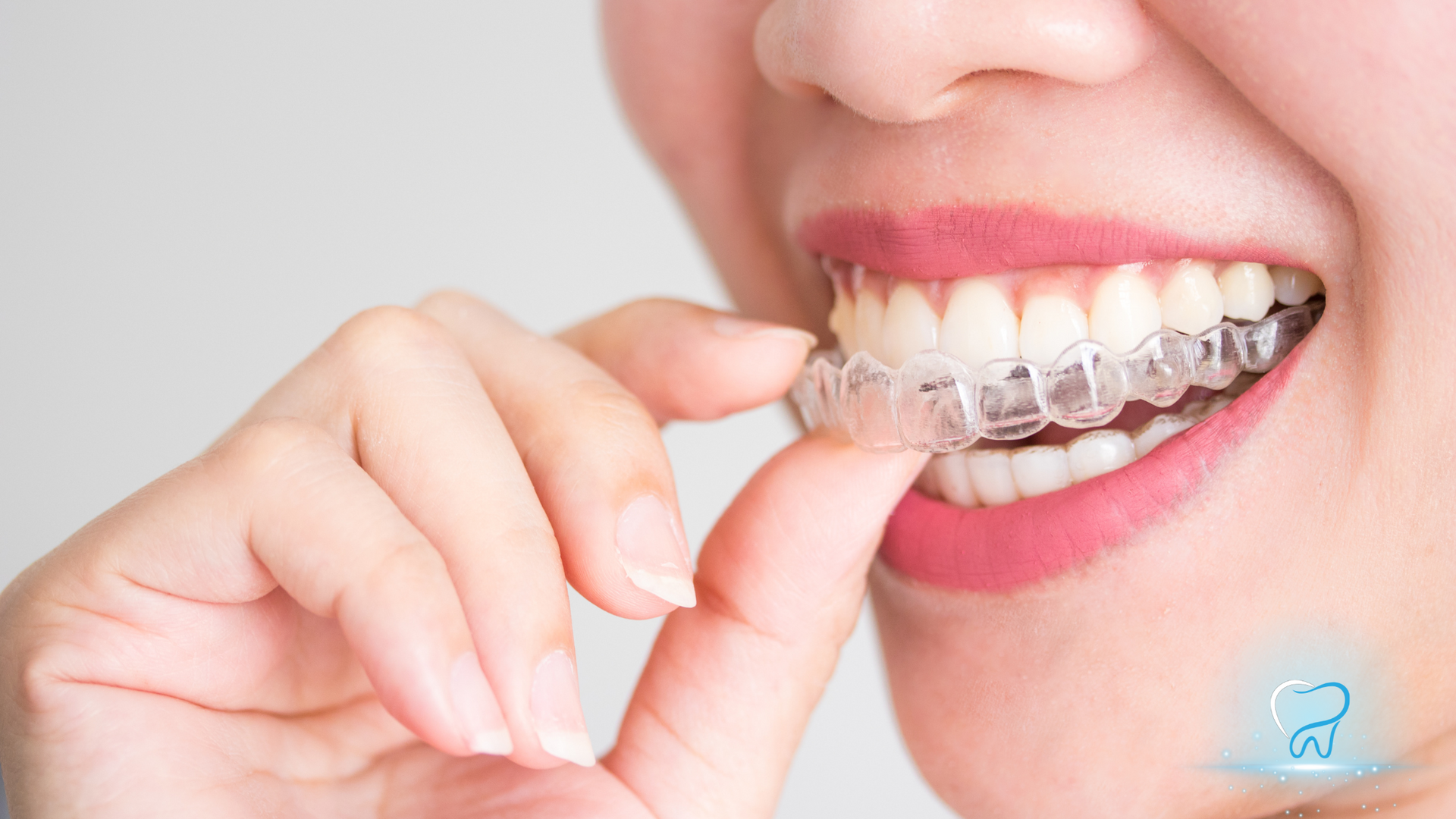 Person fitting a clear orthodontic aligner onto their teeth with fingers