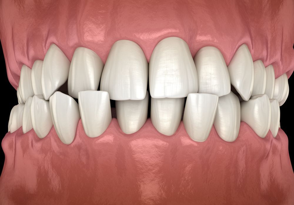 Close-up illustration of teeth with a visible gap between the upper front teeth.