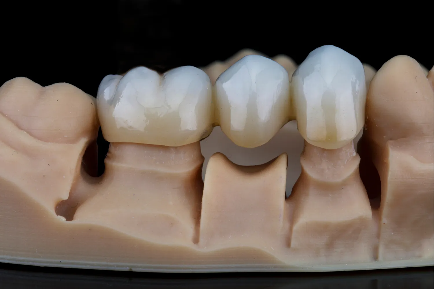 Dental model showing three tooth crowns on a pink gum base against a black background