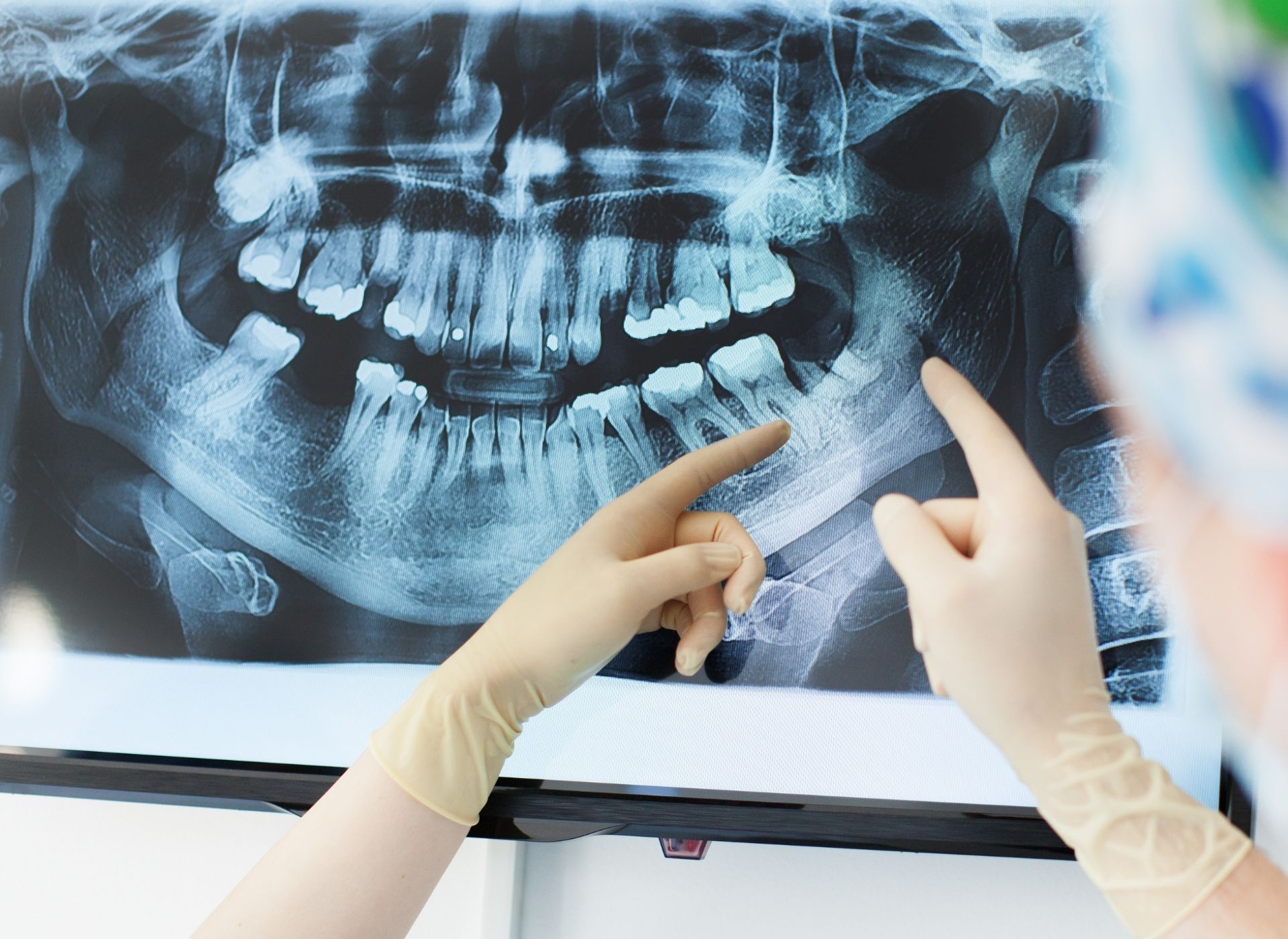 Dentist pointing at a dental X-ray on a lightbox while wearing gloves