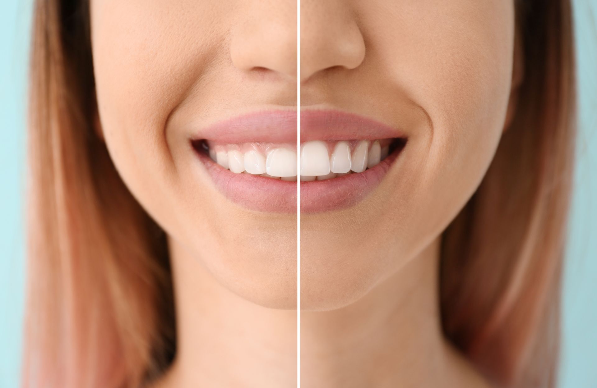 Close-up of a smiling mouth showing before-and-after teeth whitening with a vertical divider