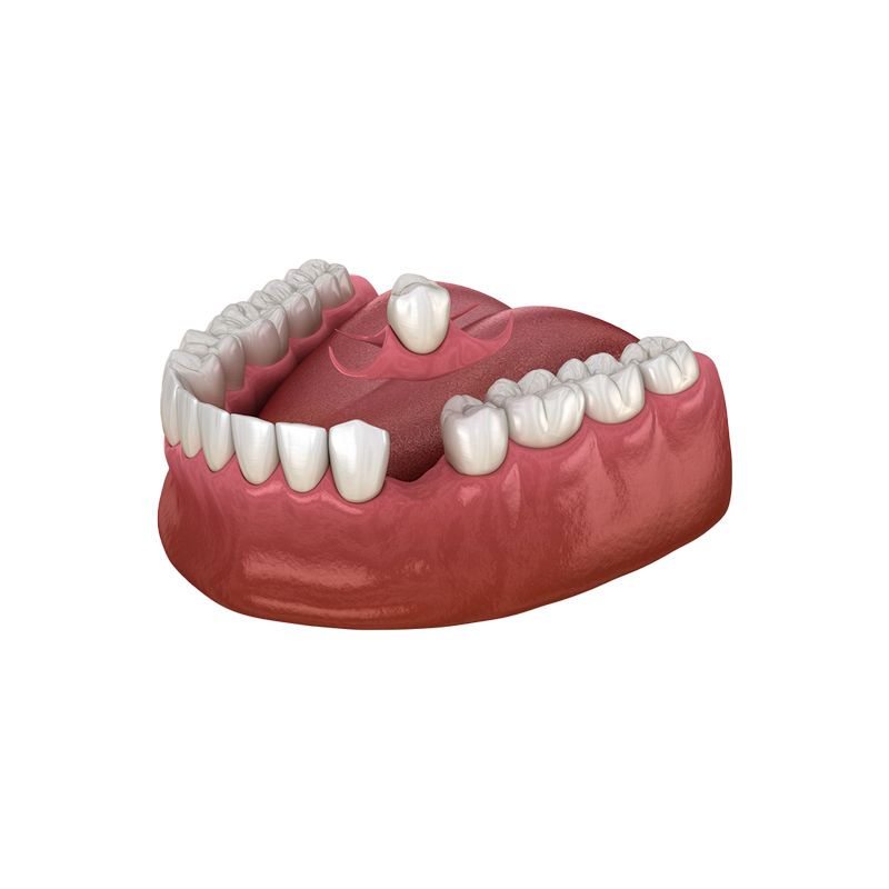 3D model of lower dentures with pink gum base and white teeth, showing a missing tooth area