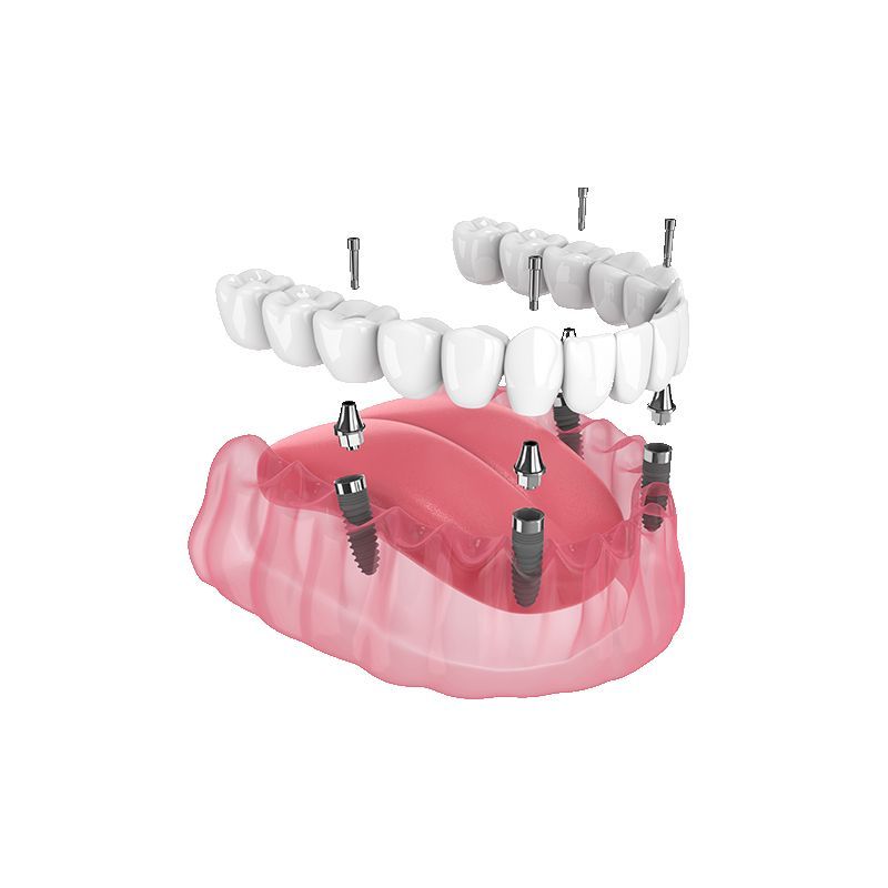Exploded view of a pink lower dental implant denture with screws and matching upper teeth bridge