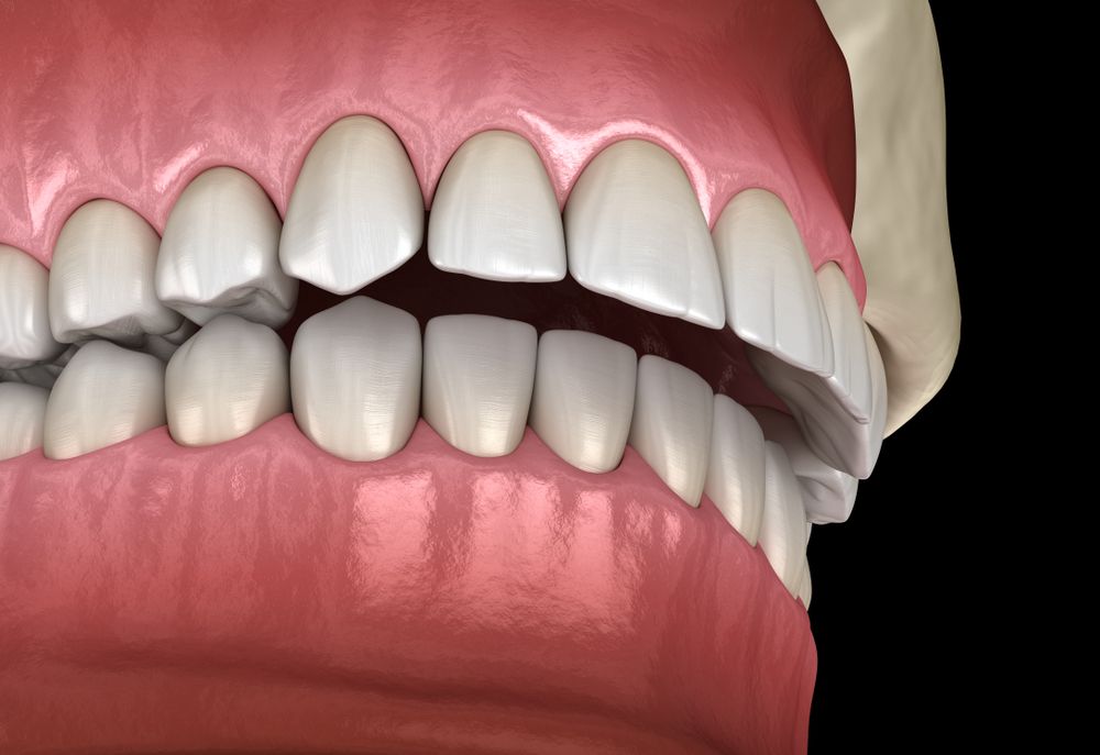 Close-up of upper and lower dentures with pink gums and white teeth.
