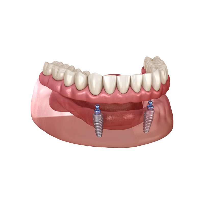 Lower jaw implant denture with two blue titanium posts supporting pink and white teeth