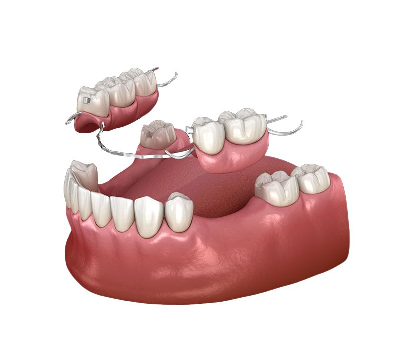 Illustration of removable partial dentures on lower and upper gums, showing metal clasps and missing teeth areas