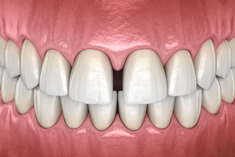 Close-up of bright white teeth and pink gums in a wide smile