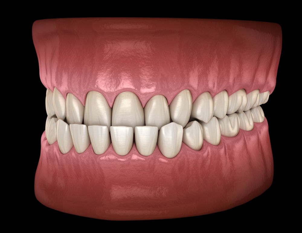 3D dental model showing aligned white teeth and pink gums on a black background