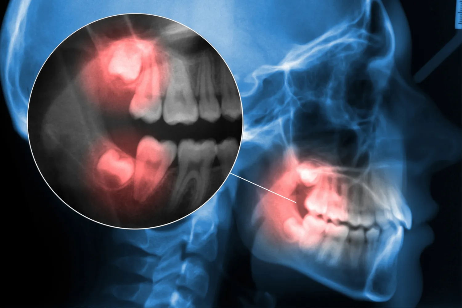 X-ray side profile of a jaw with red-highlighted teeth showing tooth pain or infection
