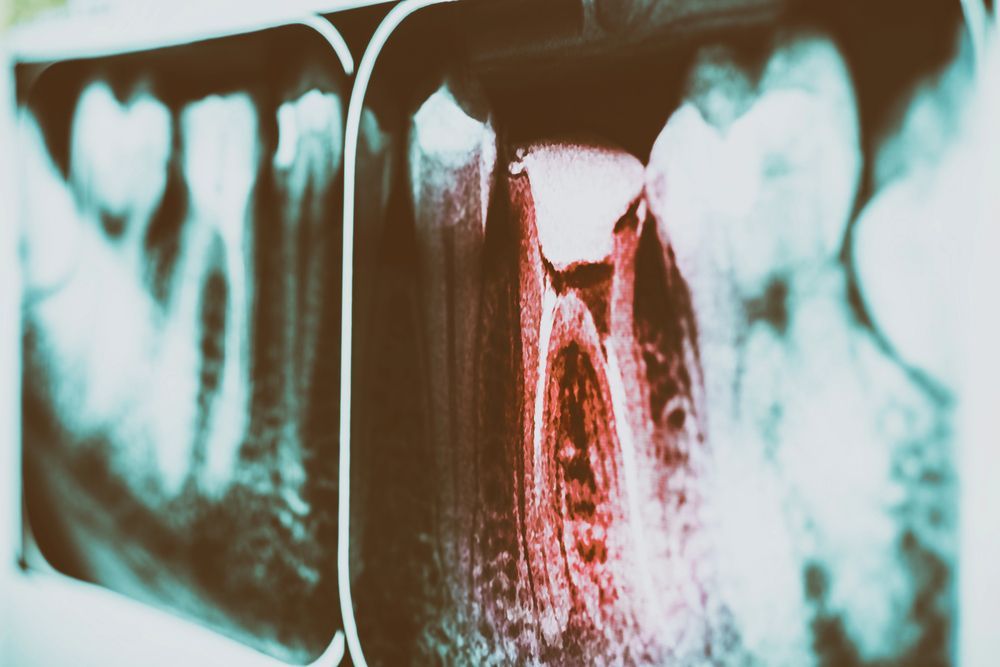 endodonzia ravenna