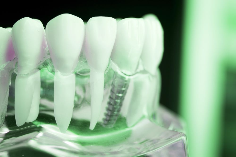 Implantologia Dentale ravenna
