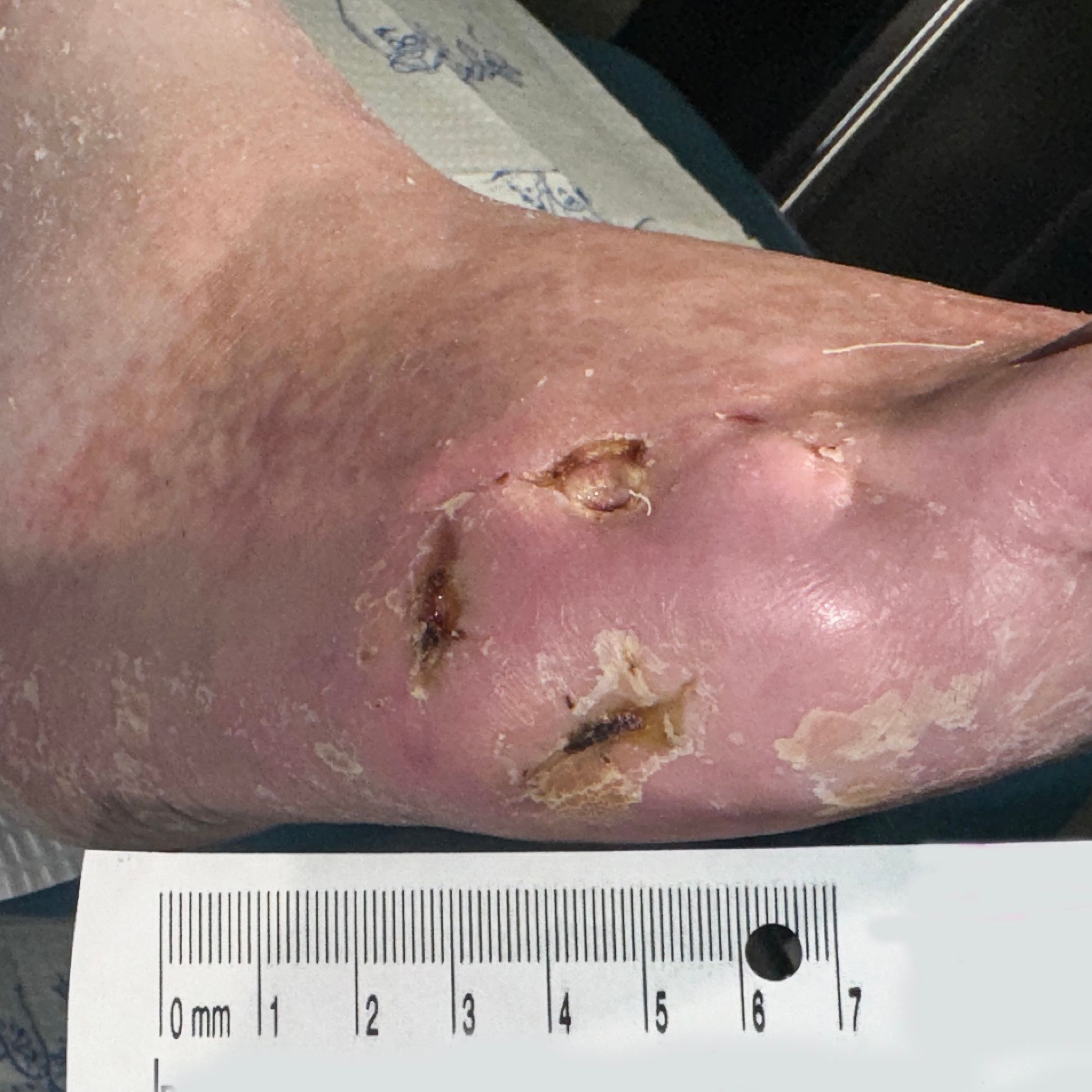 Wound Care for Multiple Side of Foot Wounds - Before