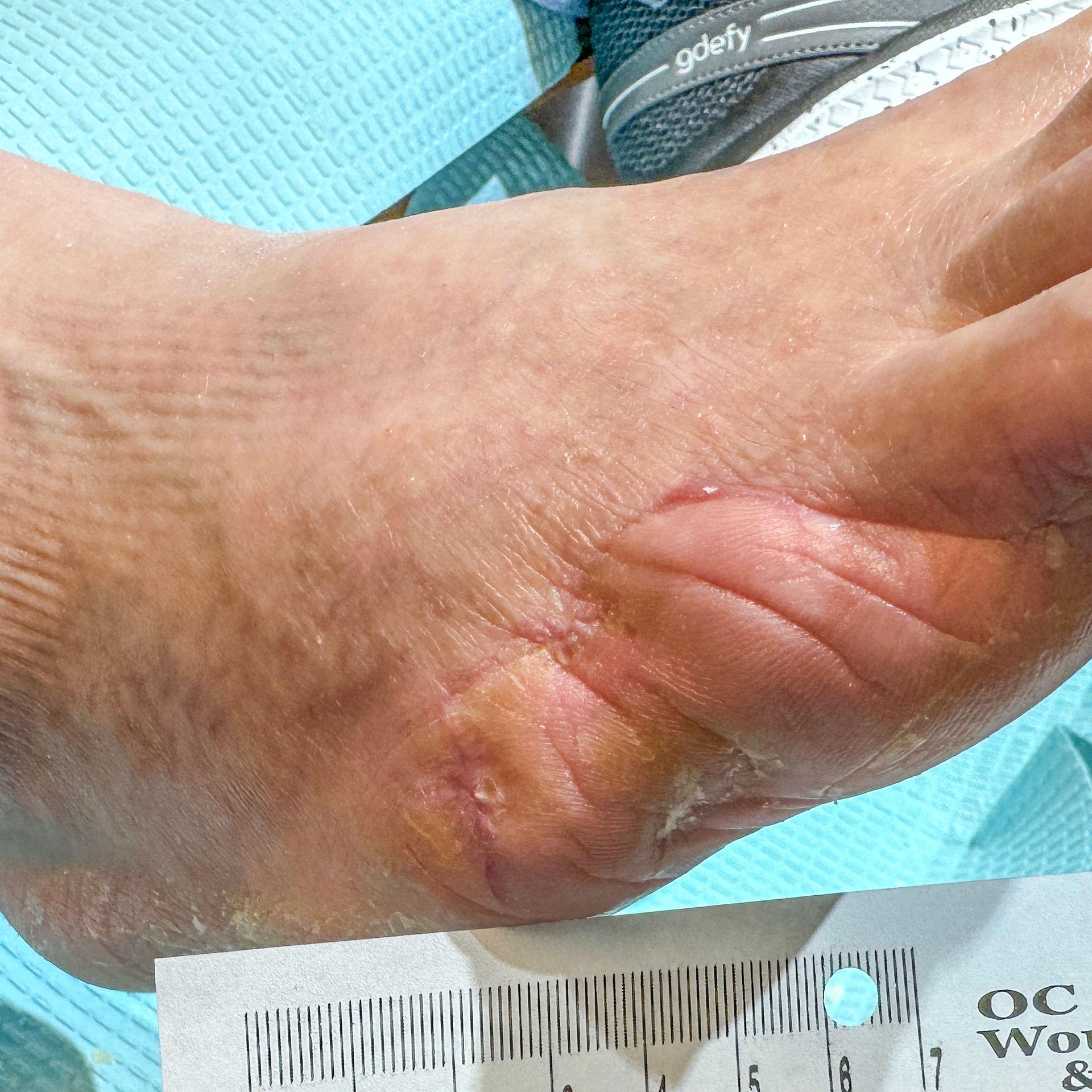 Wound Care for Multiple Side of Foot Wounds - After