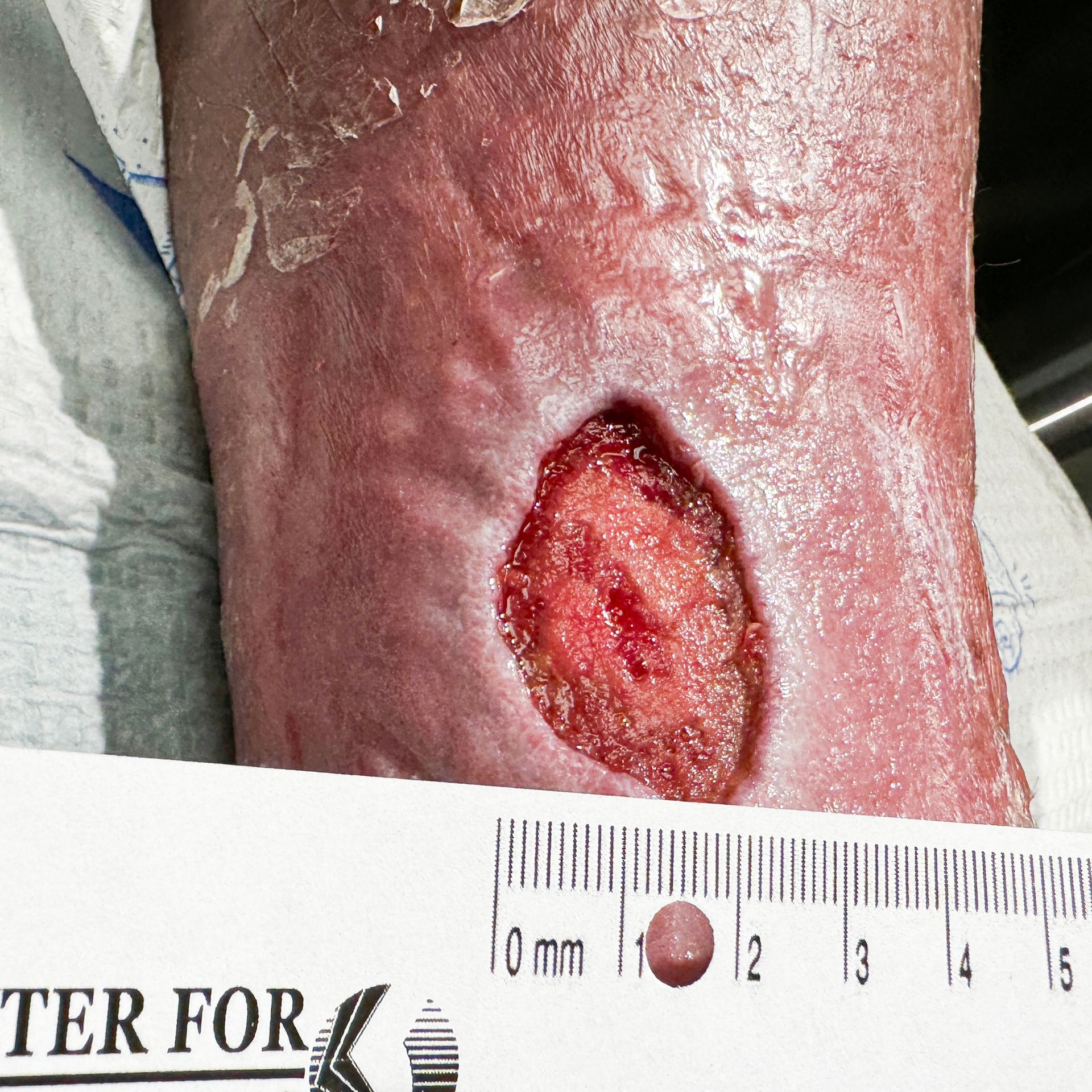 Wound Care for 2 x 3 mm Leg Wound - Before