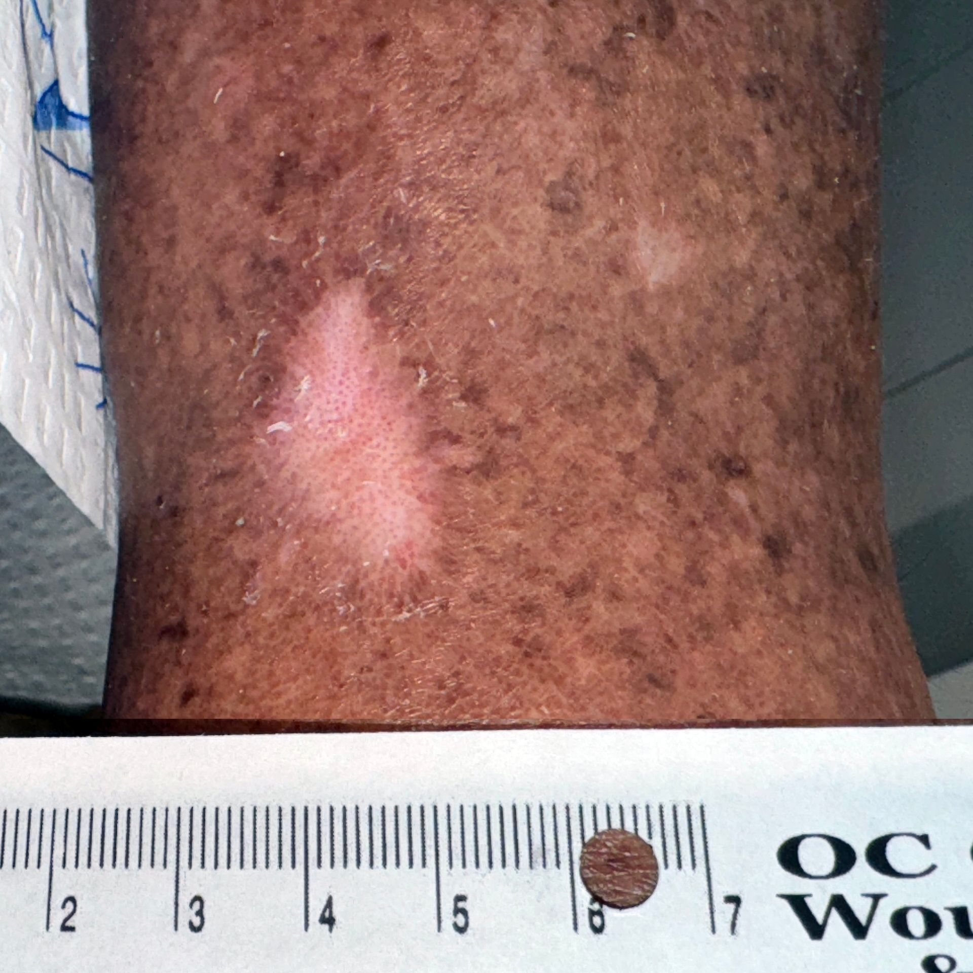Wound Care for 2 x 3 mm Leg Wound - After