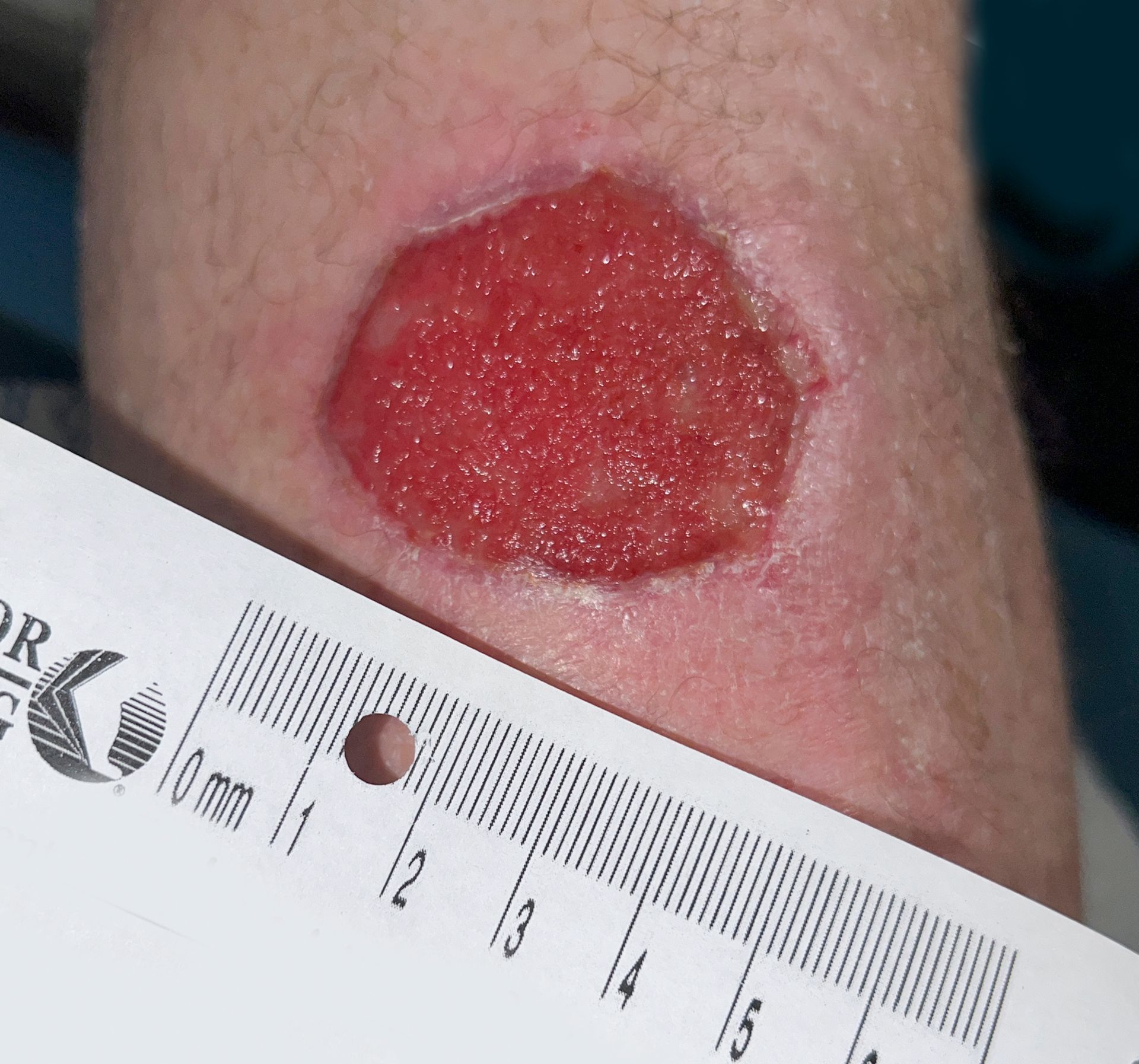 Wound Care for 3 x 3 cm Top of Leg Wound - Before