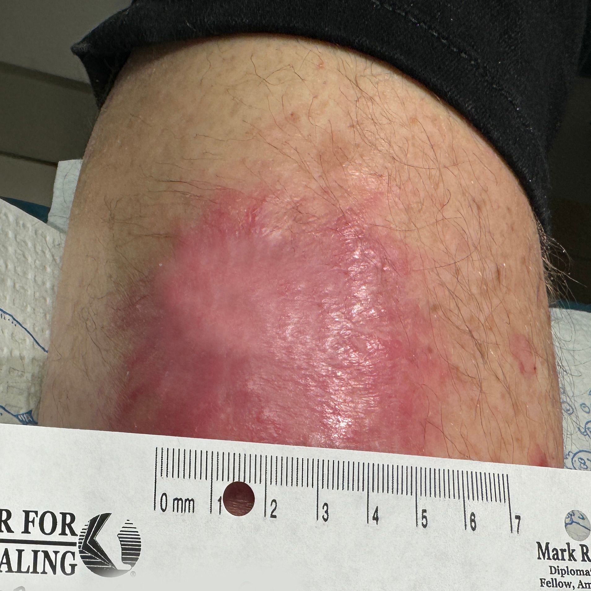 Wound Care for 3 x 3 cm Top of Leg Wound - After