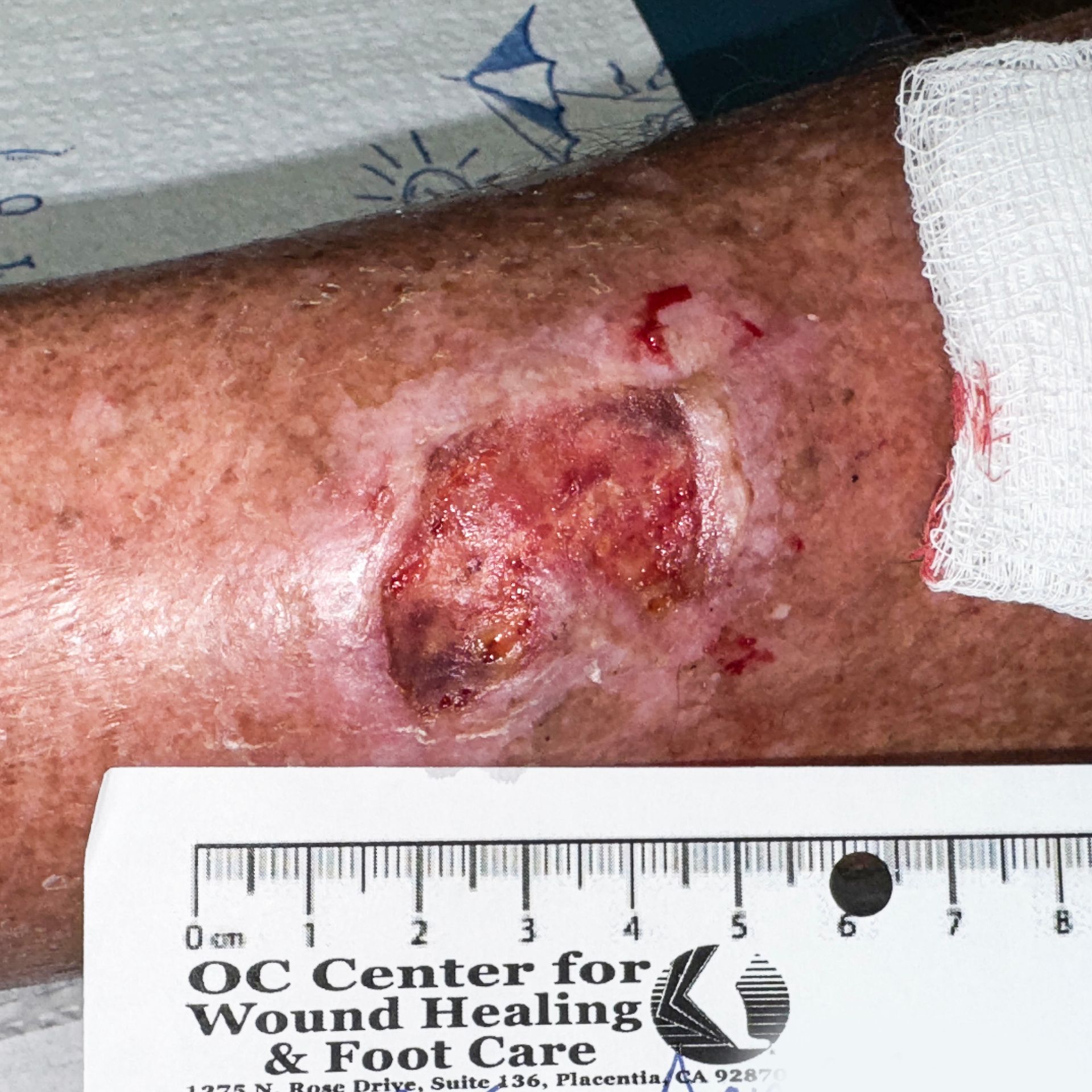 Wound Care for 3 x 2 cm Inside Leg Wound - Before