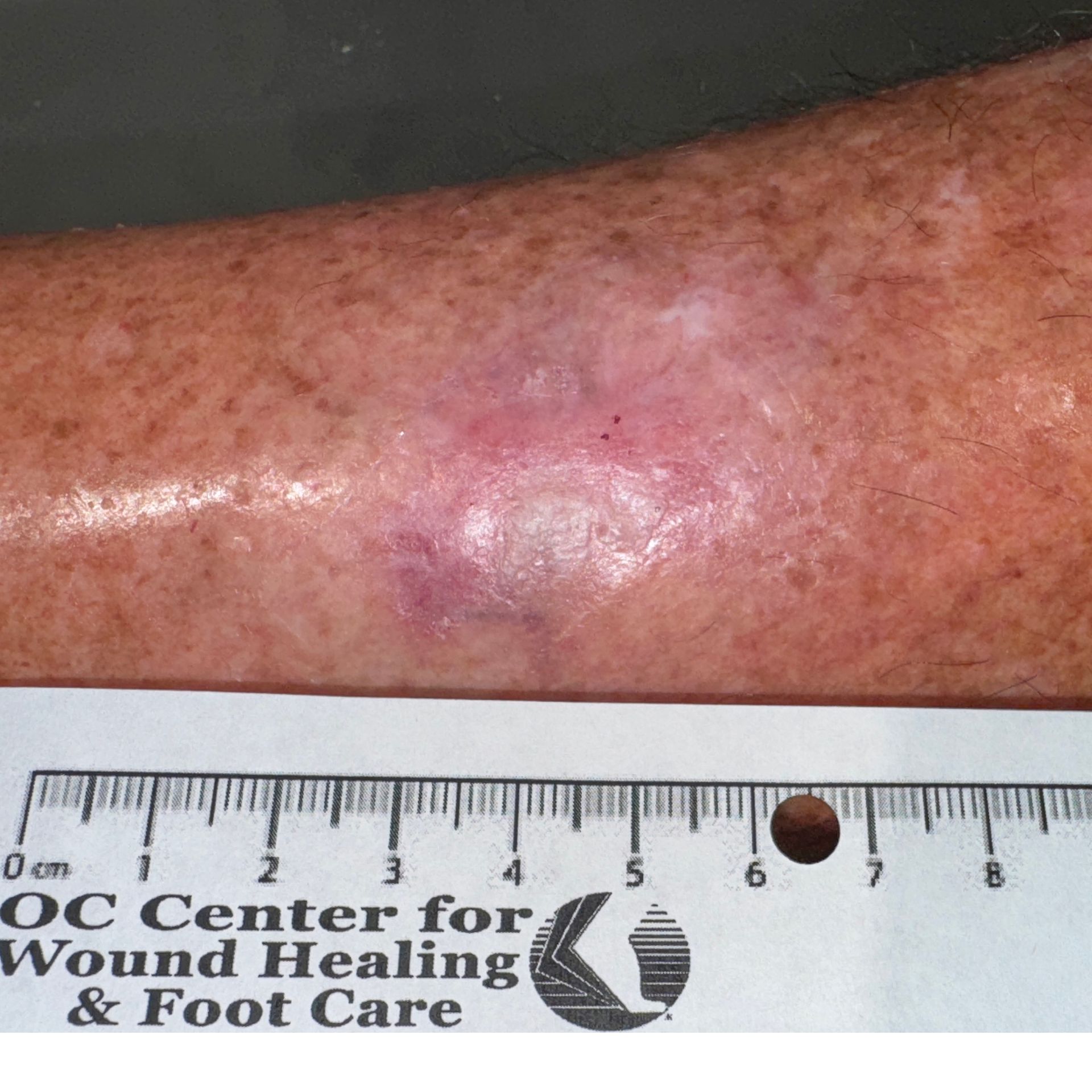 Wound Care for 3 x 2 cm Inside Leg Wound - After
