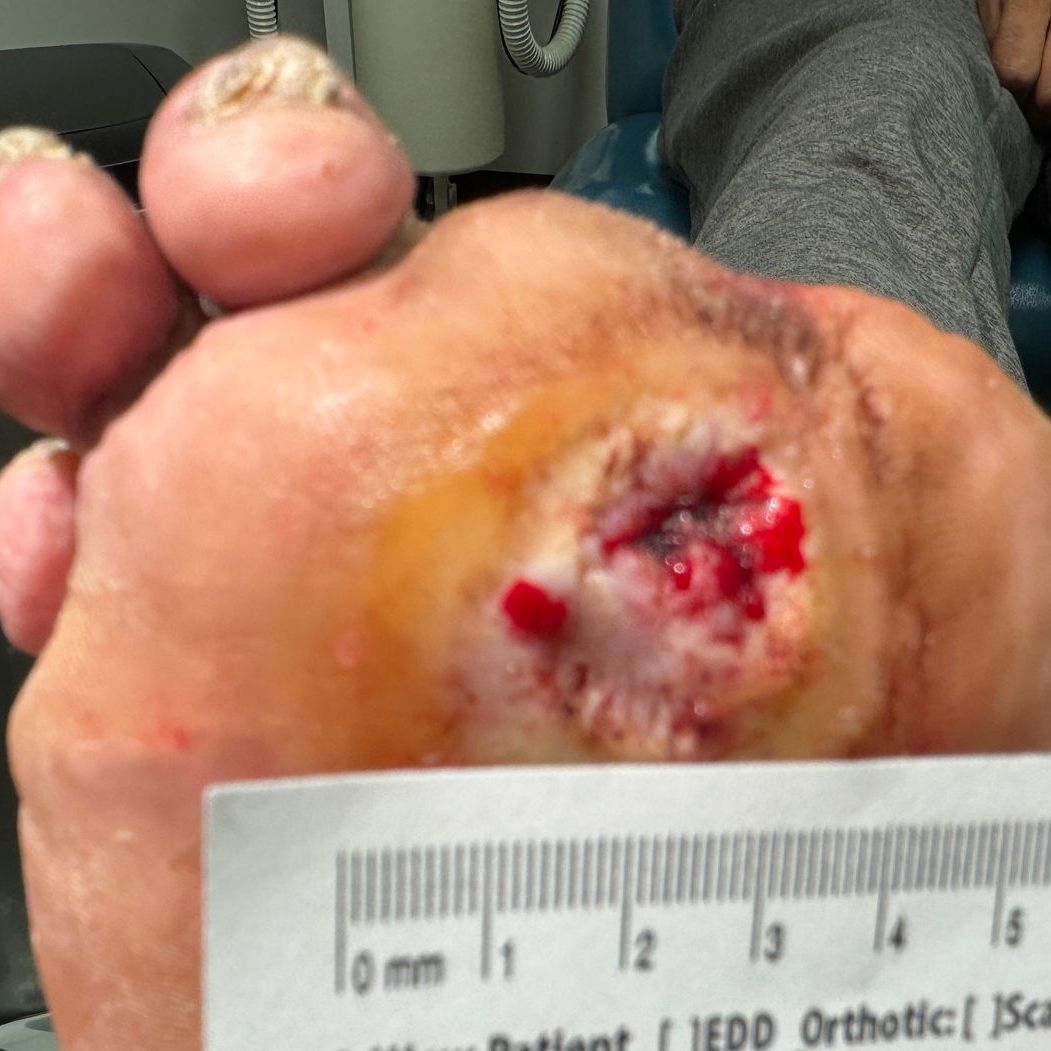 Wound Care for 3 x 3 cm Ball of Foot Wound - Before