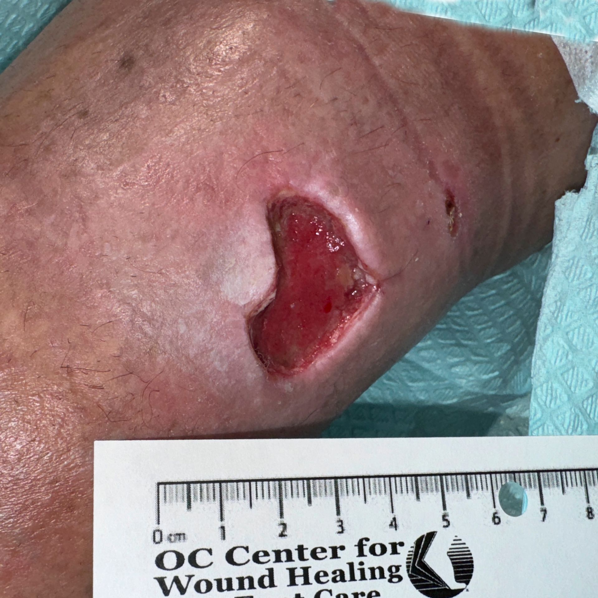Wound Care for 3 x 3 cm Inside Ankle Wound - Before
