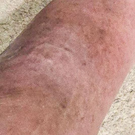 Wound Care for 3 x 3 cm Inside Ankle Wound - After