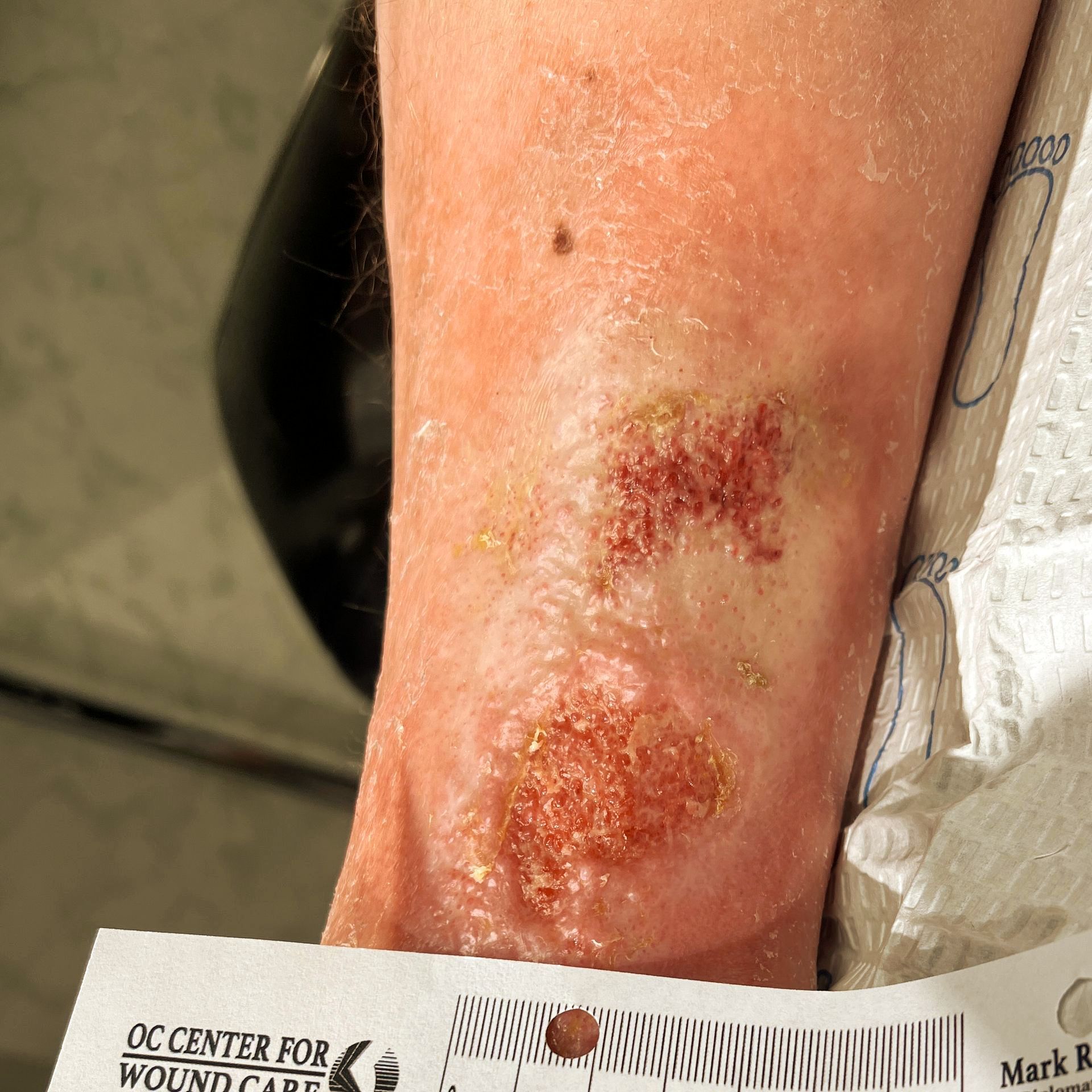 Wound Care for 4 x 7 cm Side of Leg Wound - Before