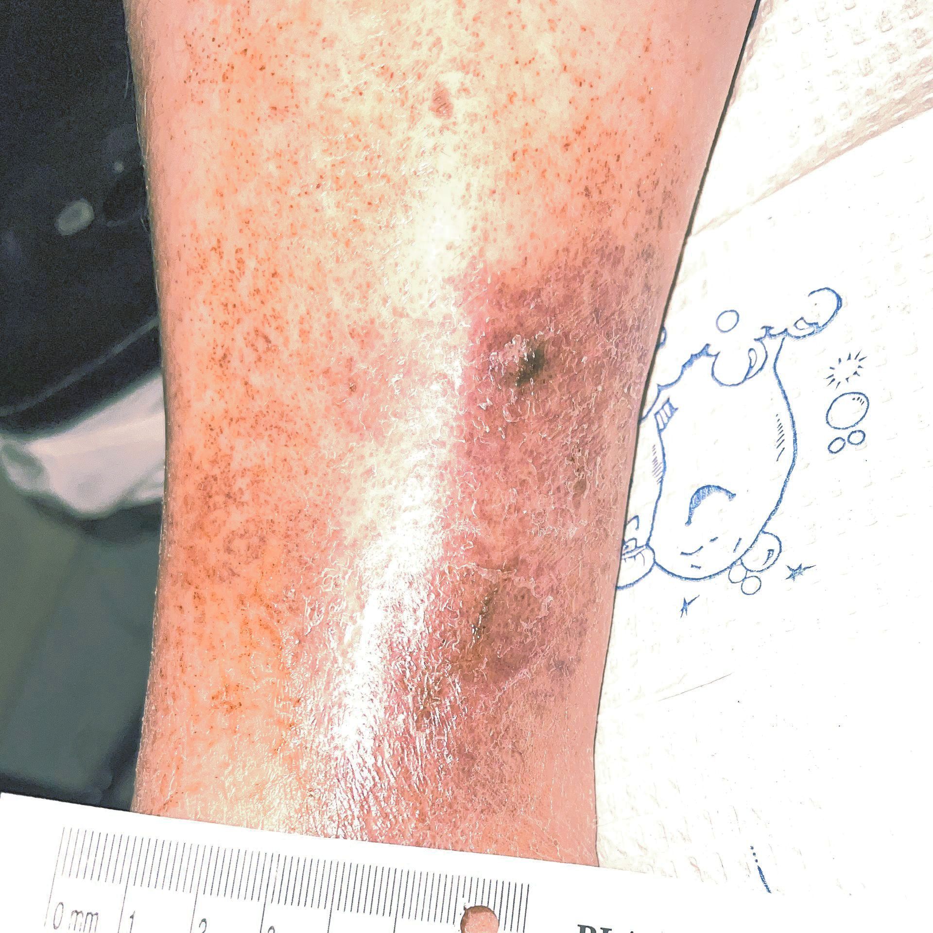 Wound Care for 4 x 7 cm Side of Leg Wound - After