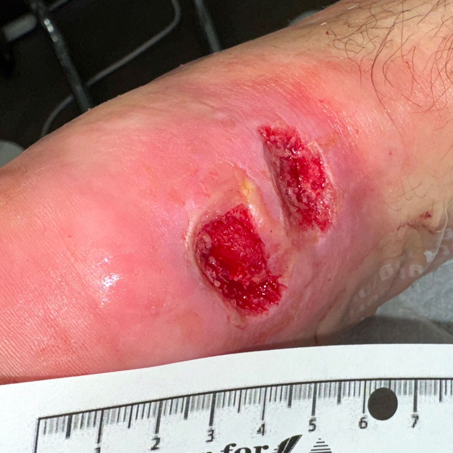Wound Care for 4 x 7 mm Side of Leg Wound - Before