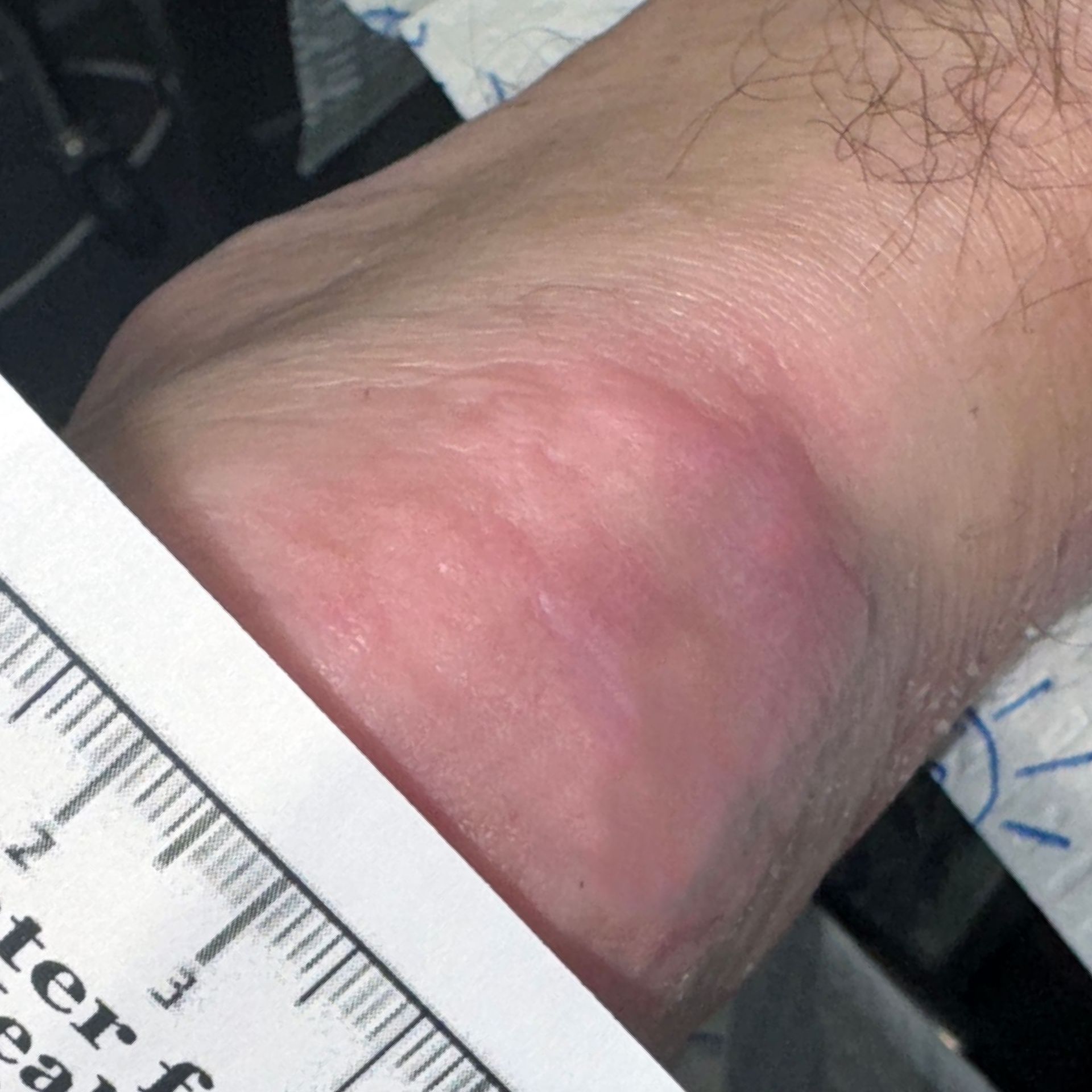 Wound Care for 4 x 7 mm Side of Leg Wound - After