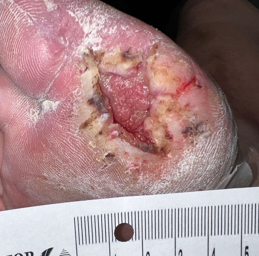Wound Care for 4 x 3 cm Ball of Foot Wound - Before