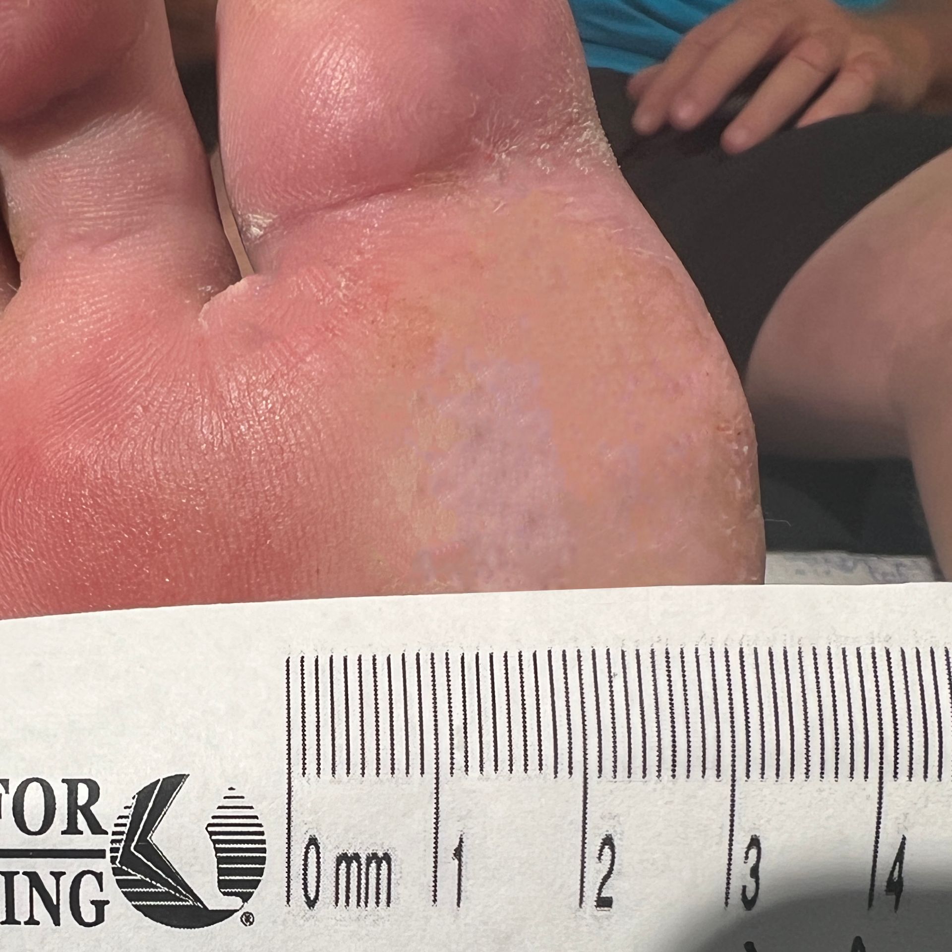 Wound Care for 4 x 3 cm Ball of Foot Wound - After
