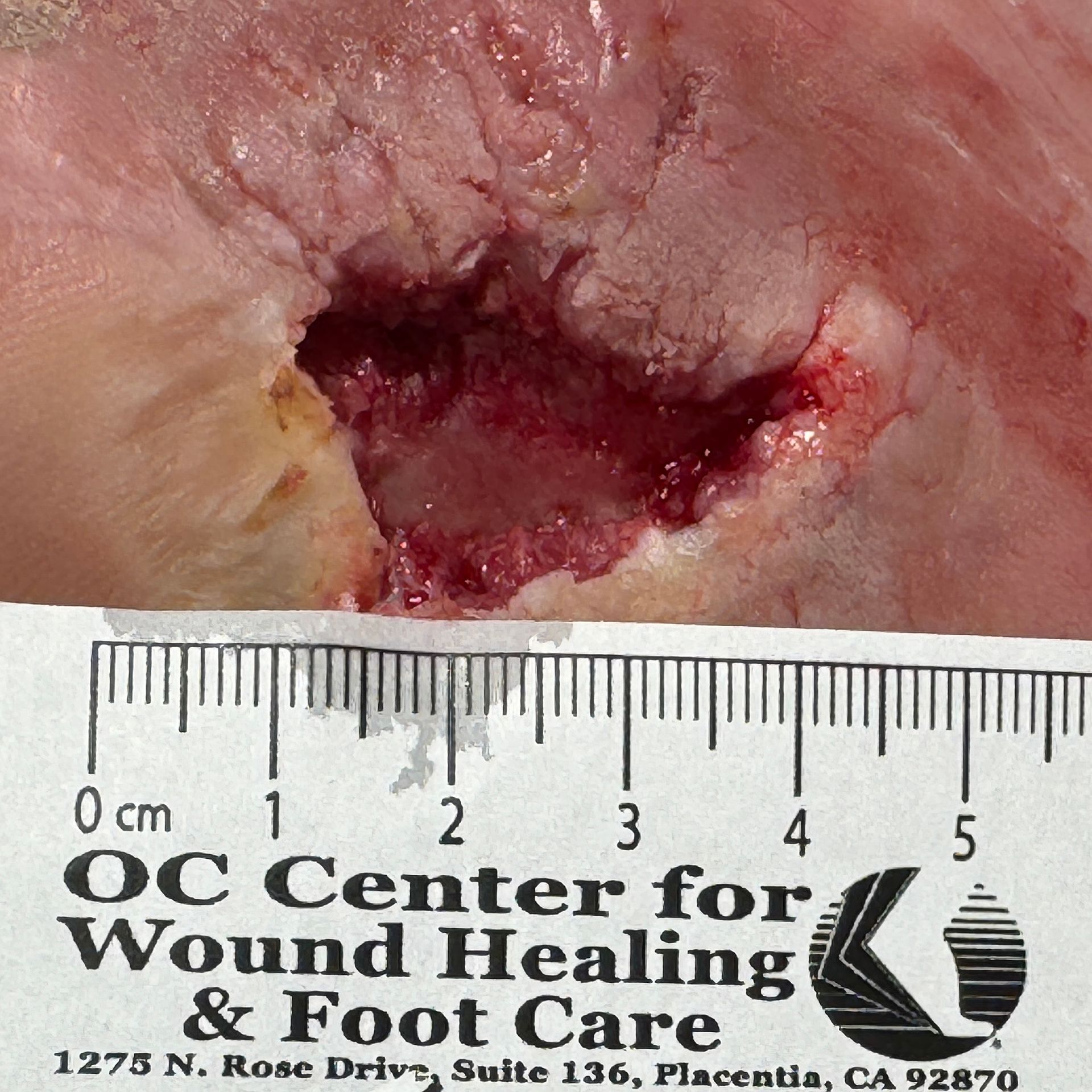 Wound Care for 4 x 3 cm Side of Foot Wound - Before