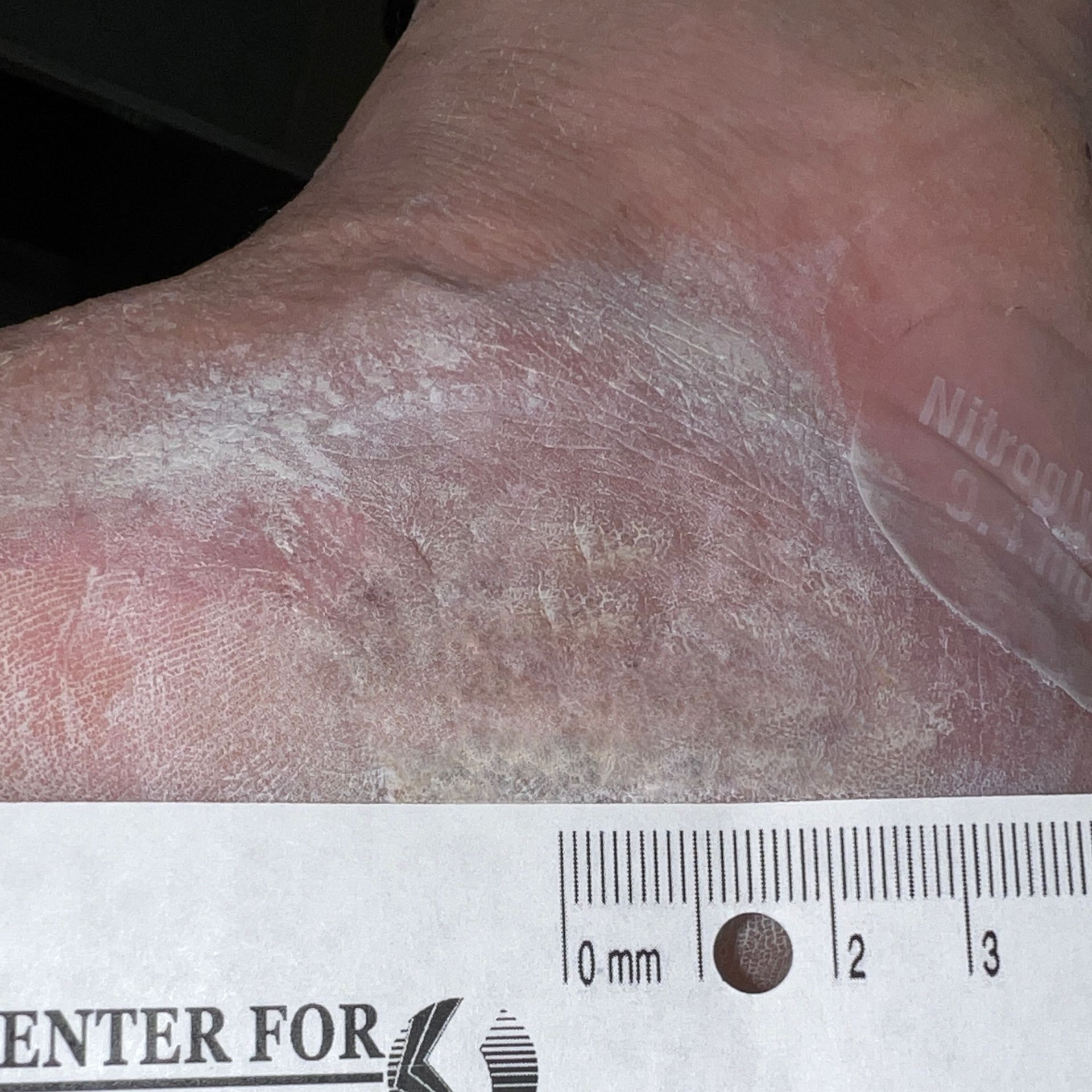Wound Care for 4 x 3 cm Side of Foot Wound - After