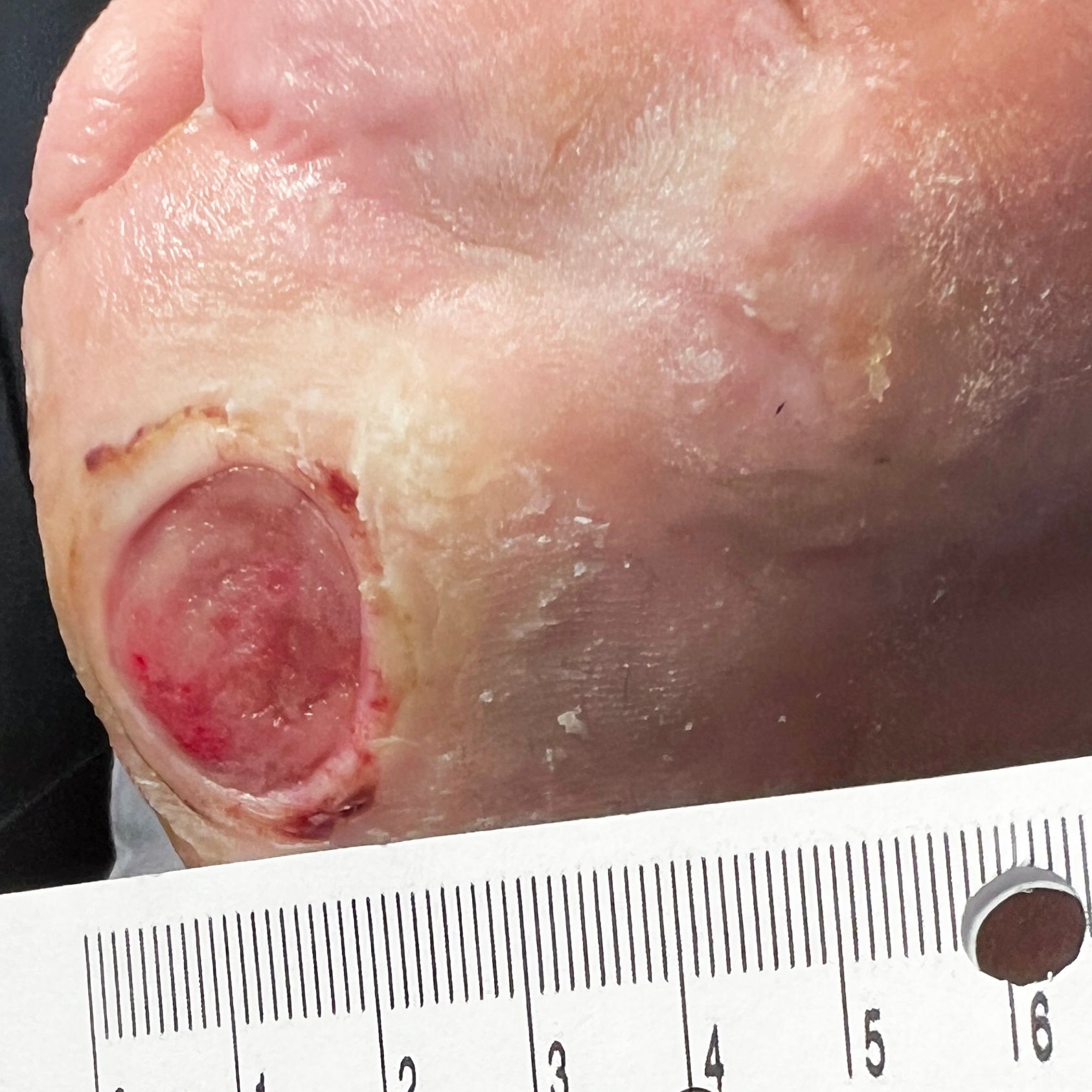 Wound Care for 2 x 3 cm Outside Bottom of Foot Wound - Before