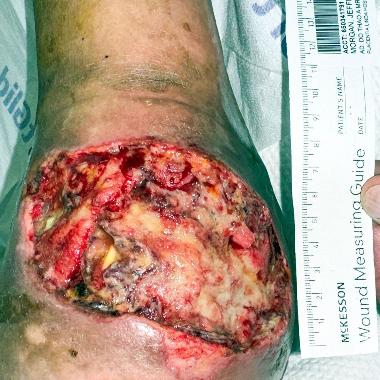 Wound Care for 13 x 8 cm Significant Foot Wound - Before