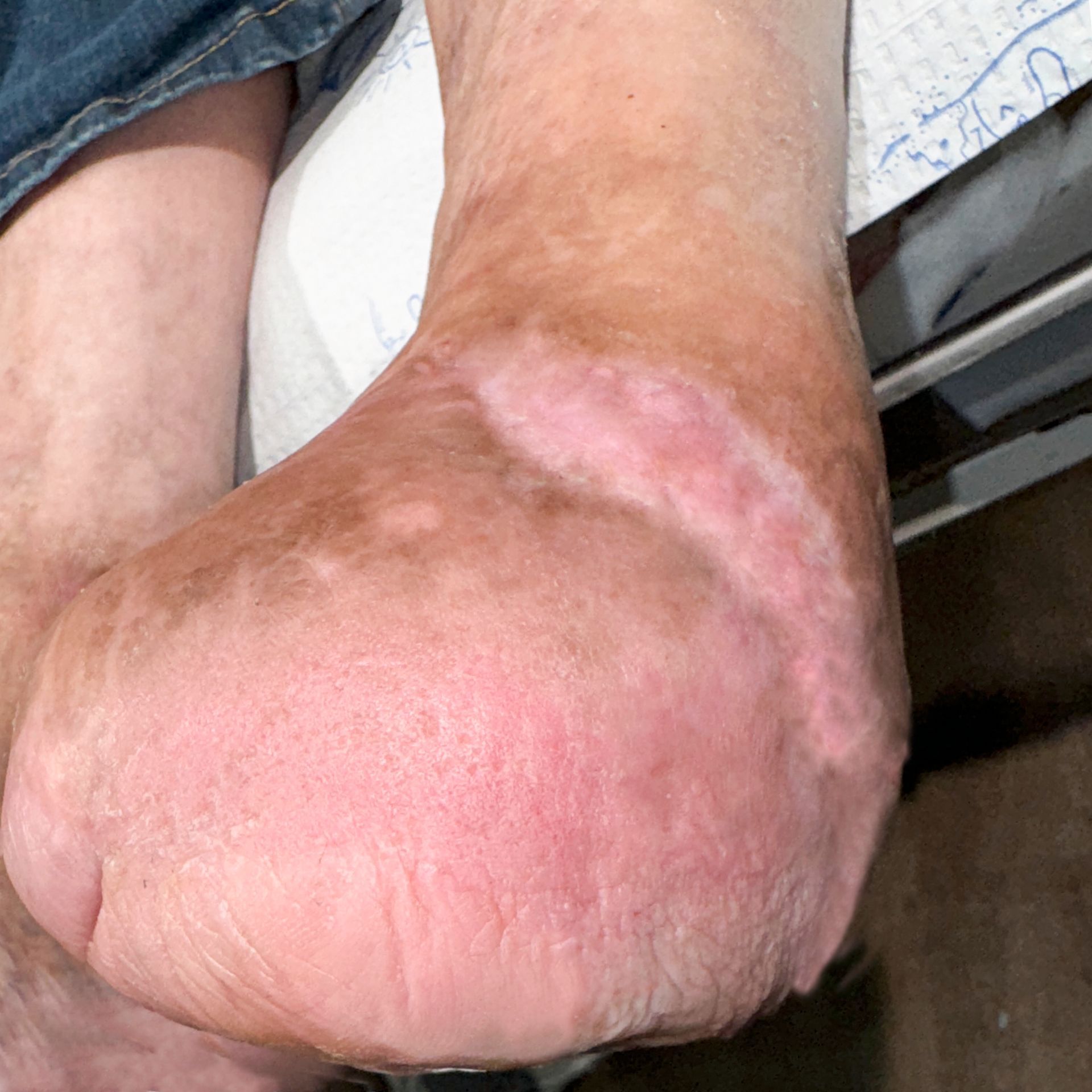 Wound Care for 13 x 8 cm Significant Foot Wound - After