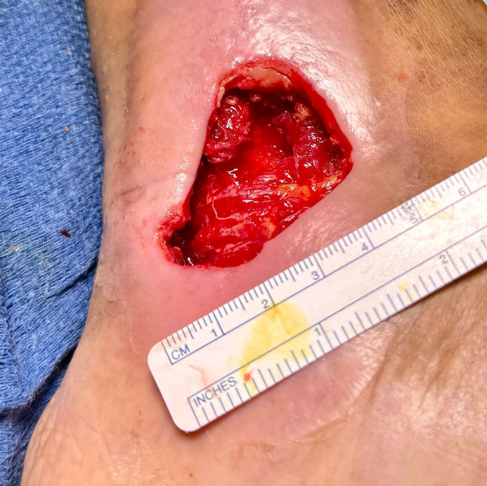 Wound Care for 5 x 4 cm Medial Wound - Before