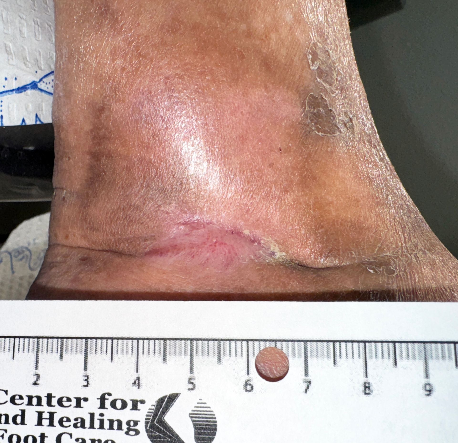 Wound Care for 5 x 4 cm Medial Wound - After