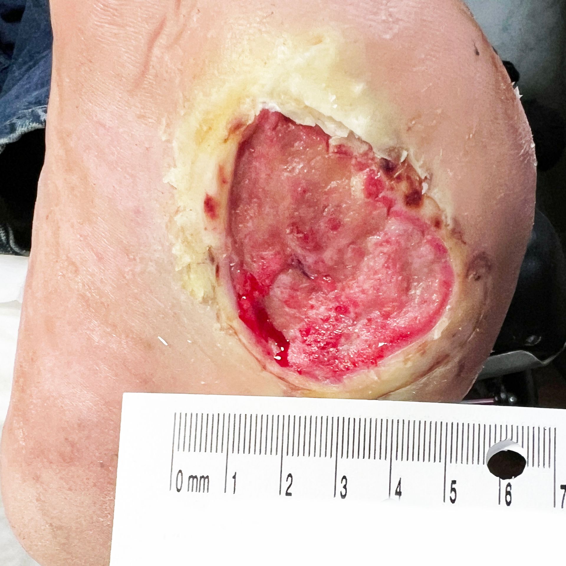 Wound Care for 5 x 5 cm Planter Wound - Before