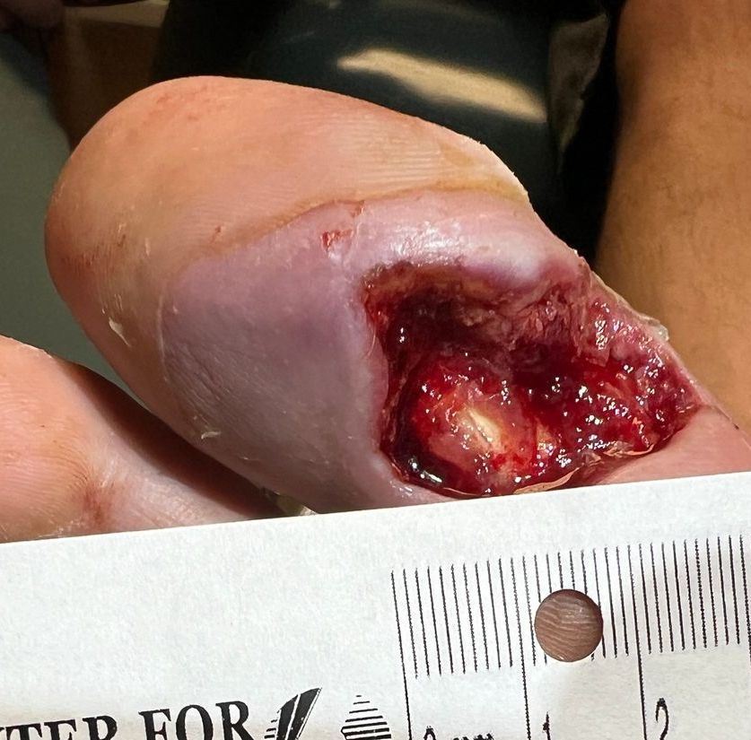 Wound Care for 3 x 2 cm Big Toe Wound - Before