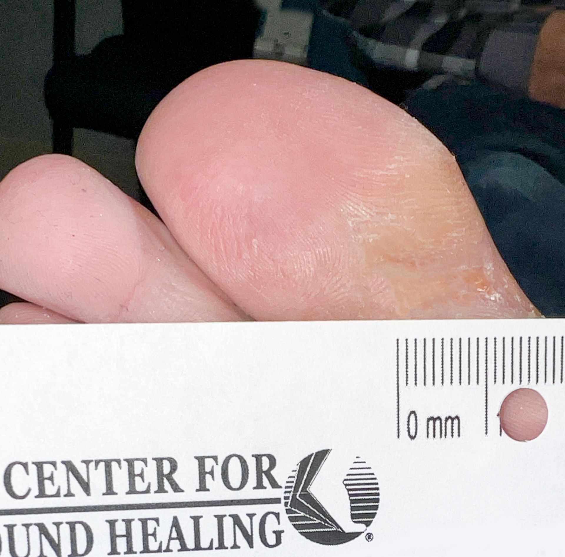 Wound Care for 3 x 2 cm Big Toe Wound - After
