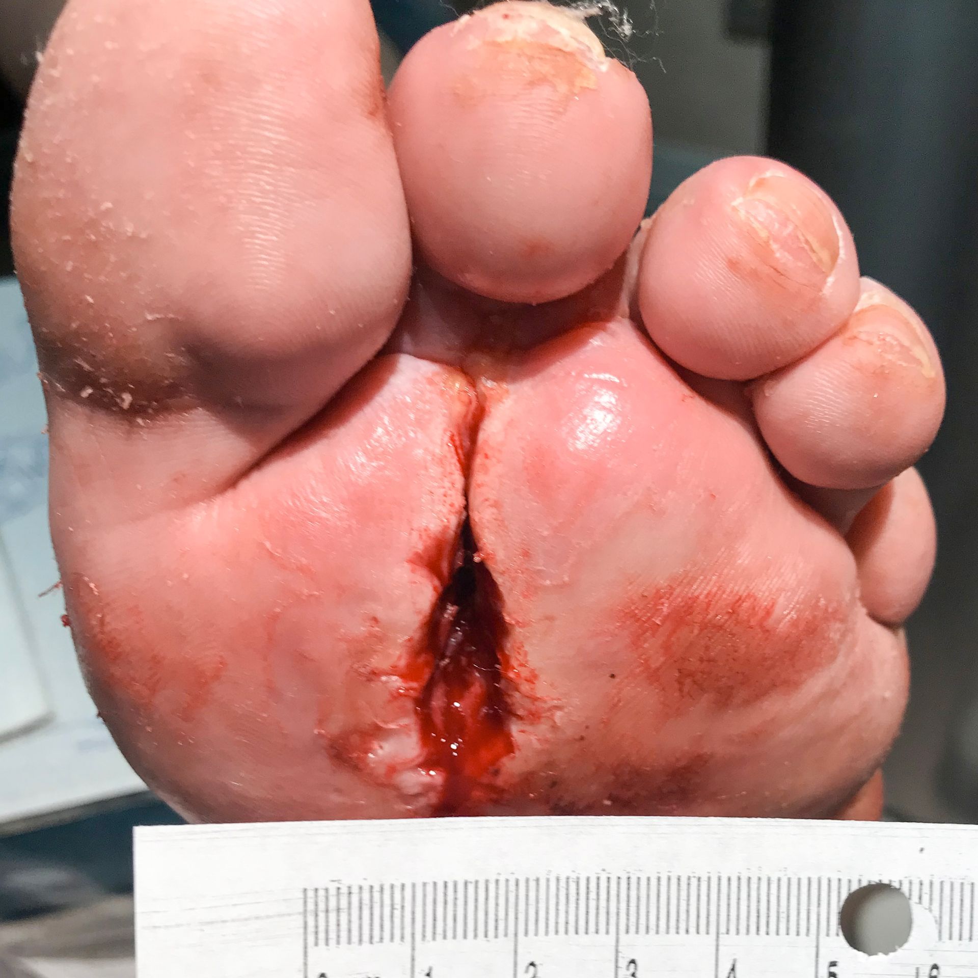 Wound Care for 2nd Toe Bottom of Foot Wound - Before